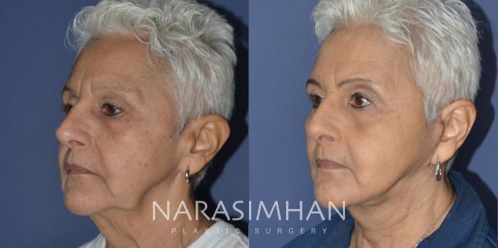 Before & After Facelift Case 210 View #2 View in Tampa, Florida