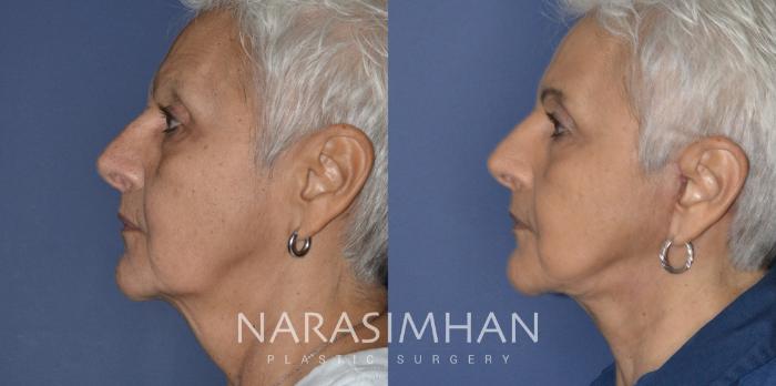 Before & After Facelift Case 210 View #3 View in Tampa, Florida