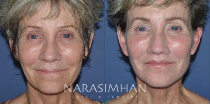 Before & After Facelift Case 287 Front View in Tampa, Florida