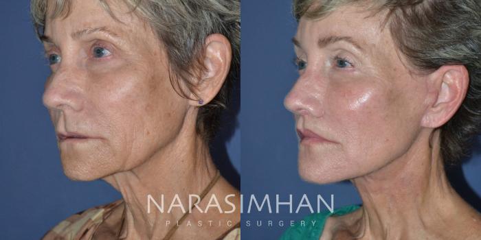 Before & After Facelift Case 287 Left Oblique View in Tampa, Florida