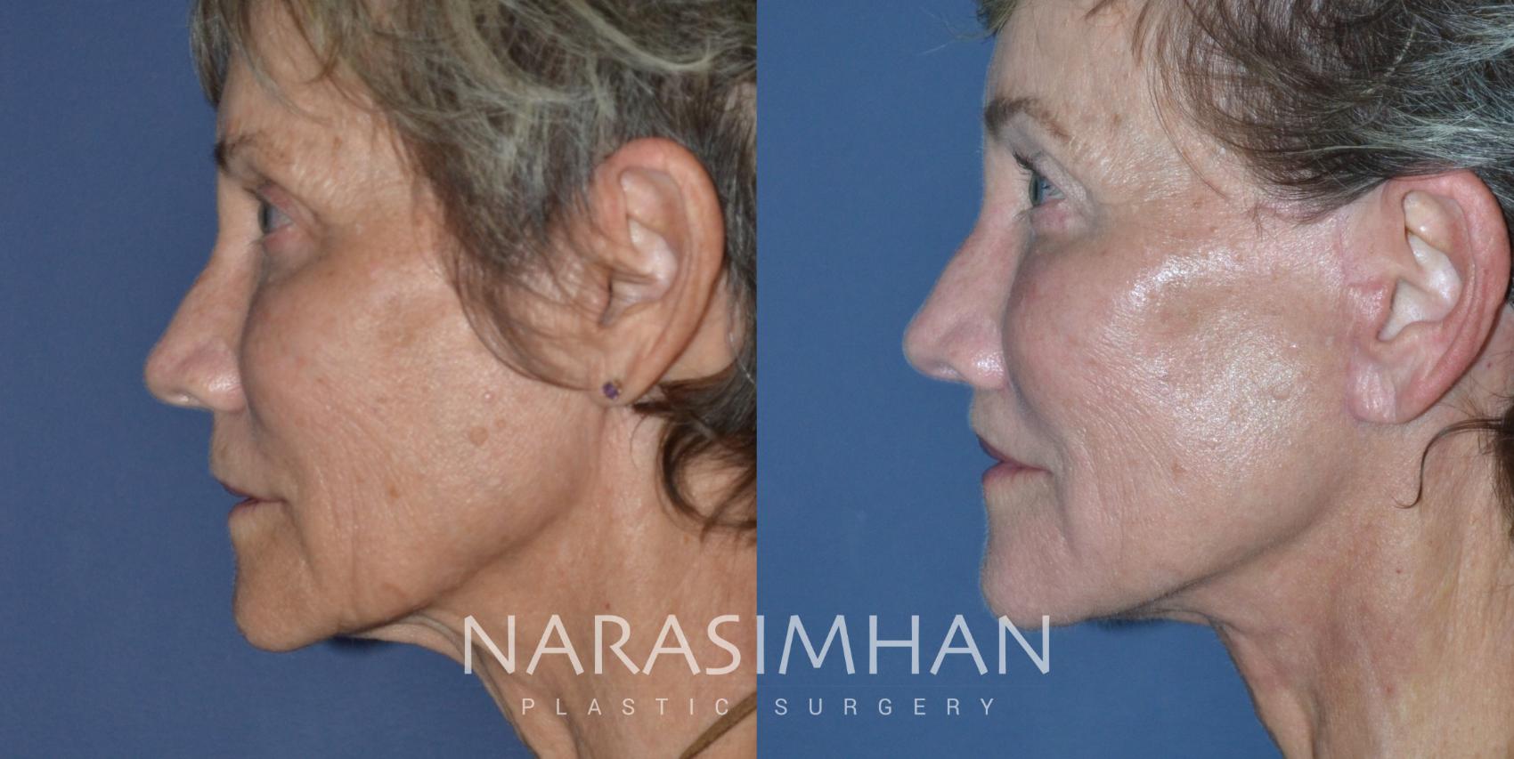 Before & After Facelift Case 287 Left Side View in Tampa, Florida