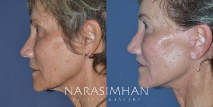 Before & After Facelift Case 287 Left Side View in St Petersburg, Florida