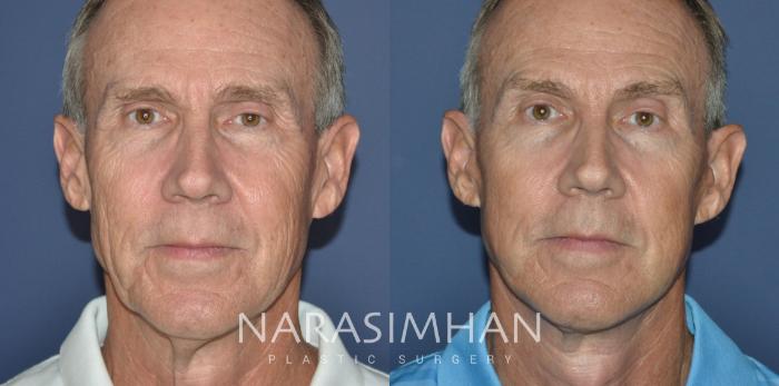 Before & After Necklift Case 307 Front View in Tampa, Florida