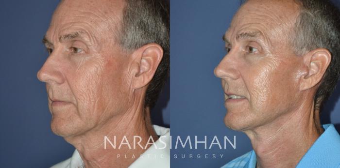 Before & After Facelift Case 307 Left Oblique View in Tampa, Florida