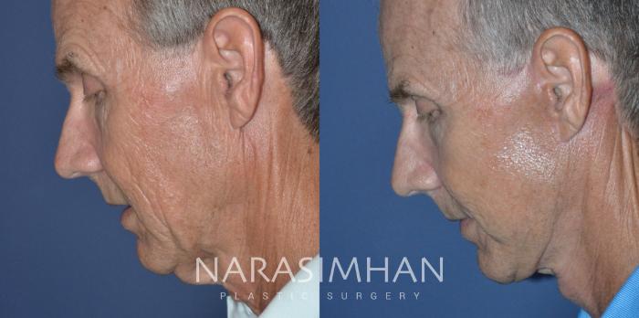 Before & After Male Facelift Case 307 Left Side View in Tampa, Florida