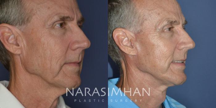 Before & After Necklift Case 307 Right Oblique View in Tampa, Florida