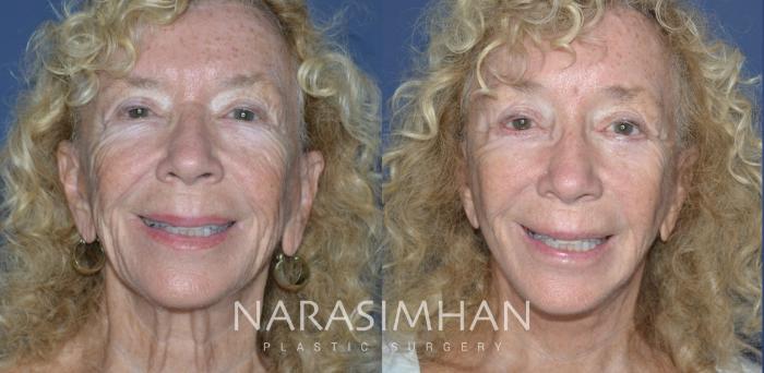 Before & After Facelift Case 313 Front View in Tampa, Florida