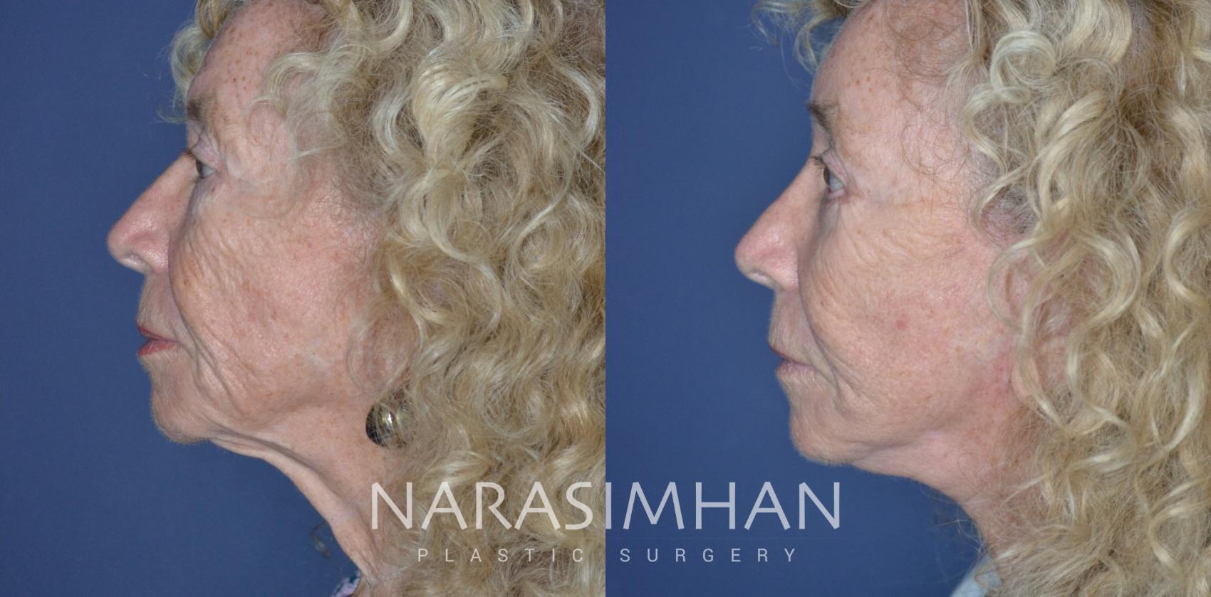 Before & After Facelift Case 313 Left Side View in Tampa, Florida