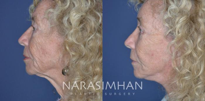 Before & After Facelift Case 313 Left Side View in St Petersburg, Florida