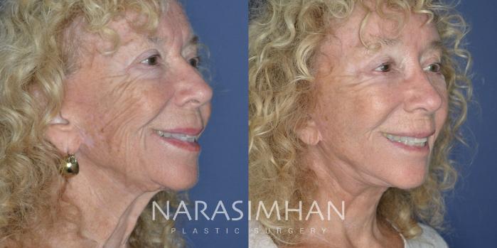 Before & After Facelift Case 313 Right Oblique View in Tampa, Florida