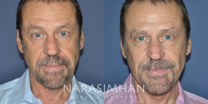 Before & After Male Facelift Case 322 Front View in Tampa, Florida