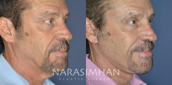 Before & After Facelift Case 322 Right Oblique View in Tampa, Florida