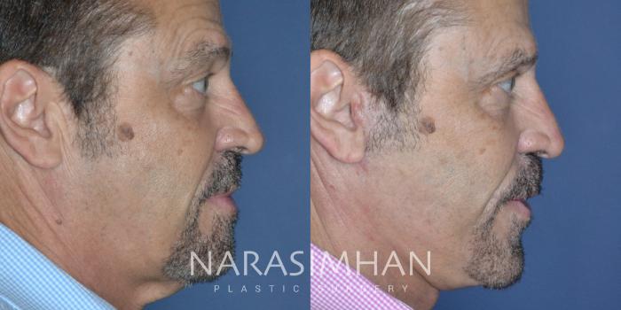 Before & After Facelift Case 322 Right Side View in Tampa, Florida