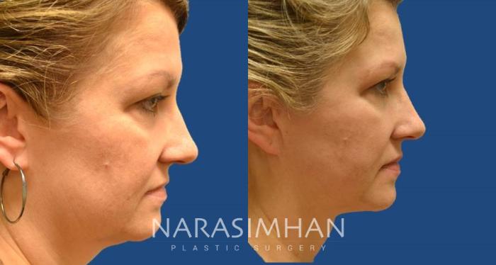 Before & After Facelift Case 38 View #1 View in St Petersburg, Florida