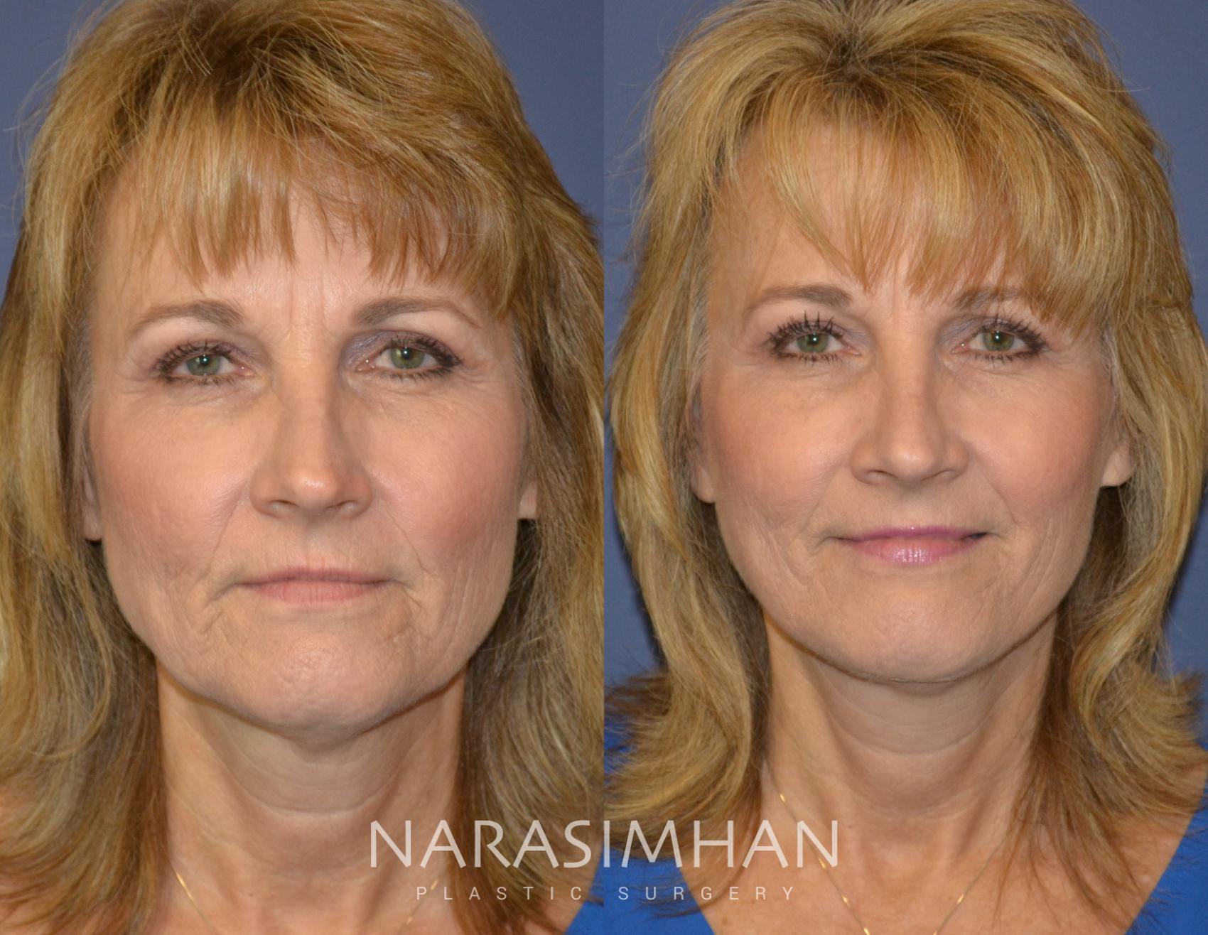 Before & After Facelift Case 79 View #1 View in Tampa, Florida