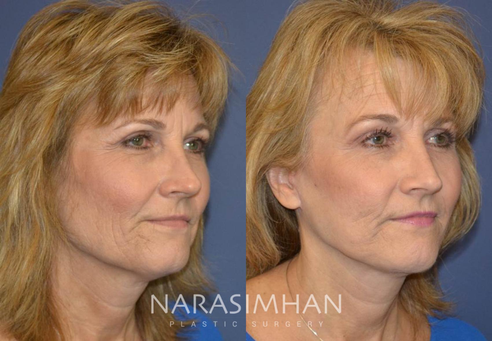 Before & After Facelift Case 79 View #2 View in St Petersburg, Florida