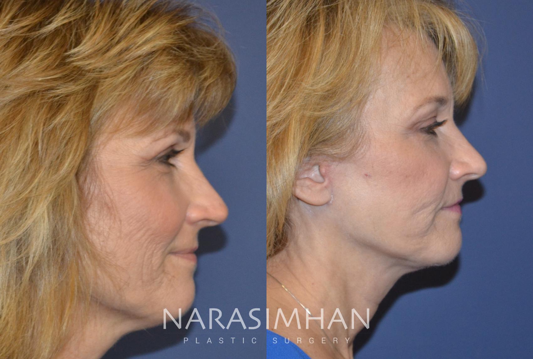 Before & After Facelift Case 79 View #3 View in St Petersburg, Florida