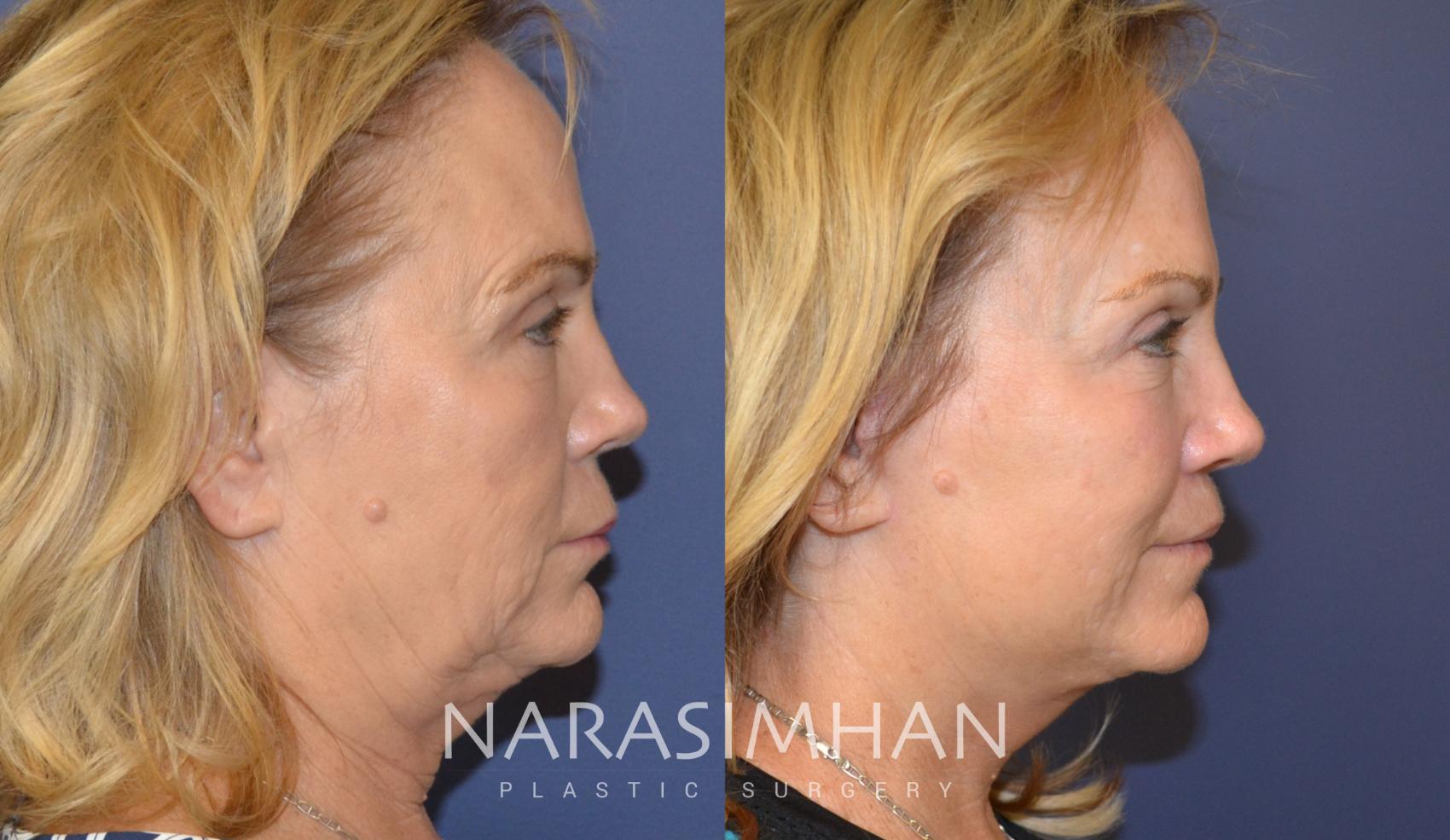 Before & After Necklift Case 83 View #1 View in St Petersburg, Florida