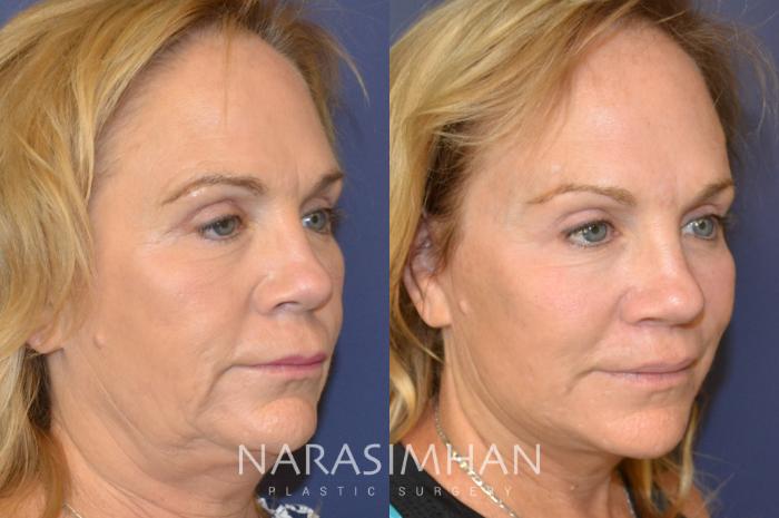 Before & After Facelift Case 83 View #3 View in St Petersburg, Florida