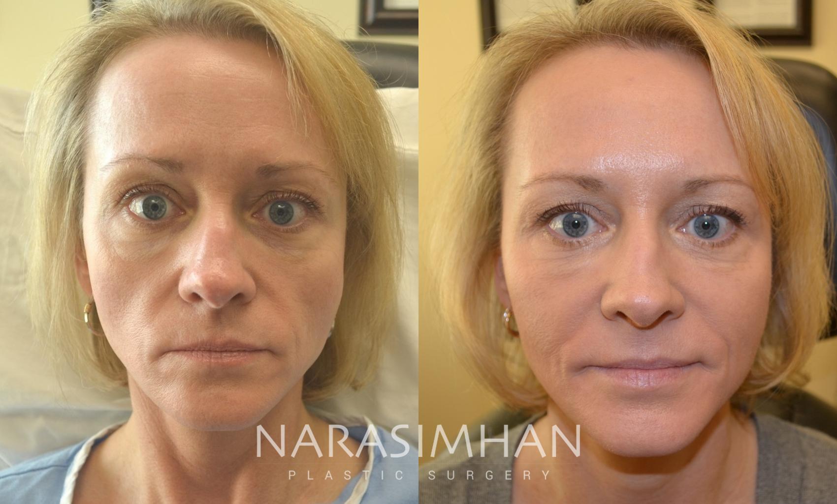 Before & After Filler Case 102 View #1 View in St Petersburg, Florida