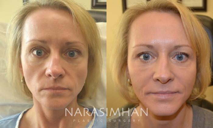 Before & After Botox  Case 102 View #1 View in Tampa, Florida