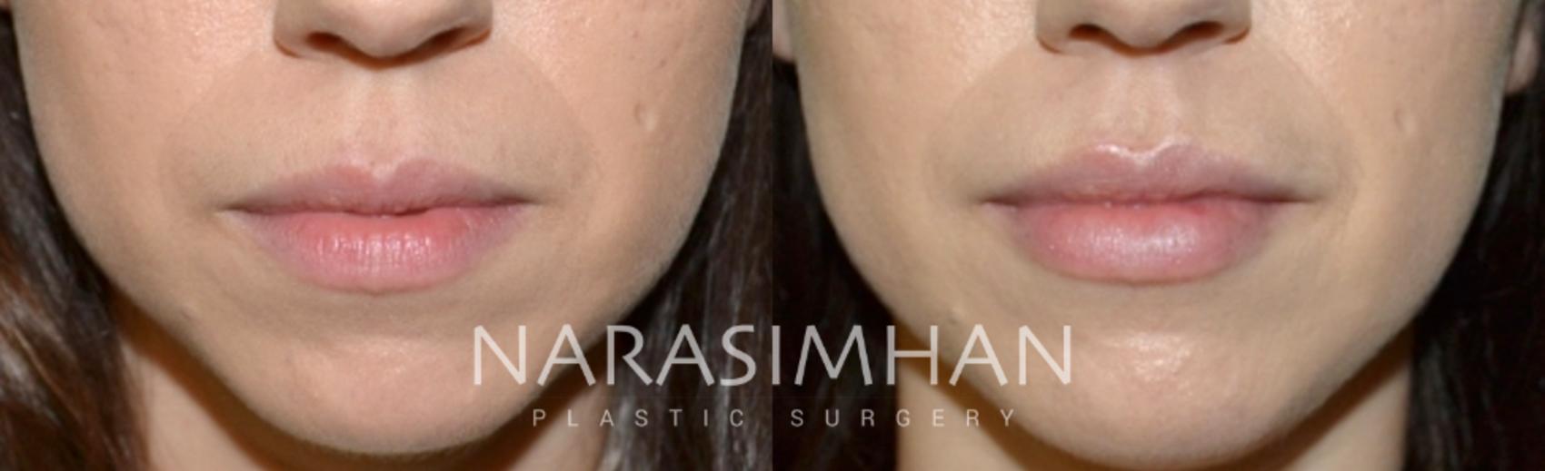 Before & After Lip Augmentation Case 152 View #1 View in St Petersburg, Florida