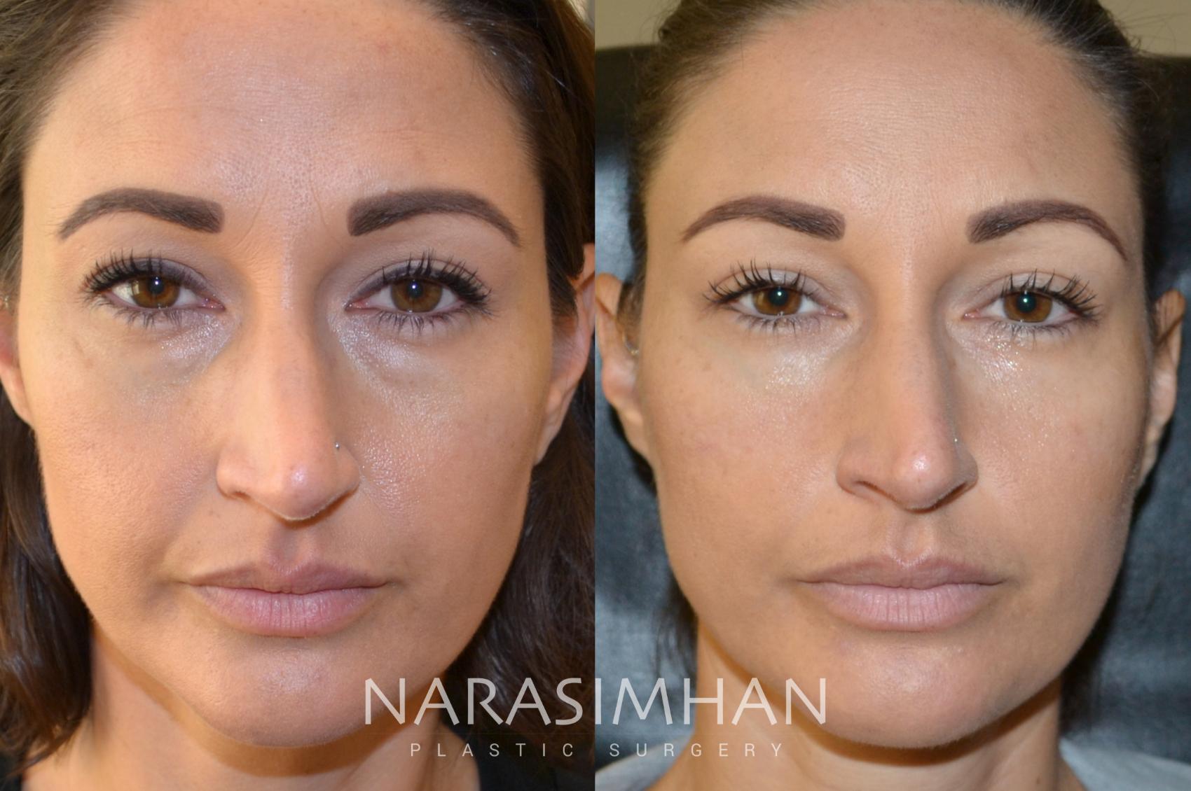 Before & After Filler Case 186 View #1 View in St Petersburg, Florida