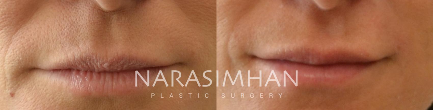 Before & After Lip Augmentation Case 115 View #1 View in St Petersburg, Florida