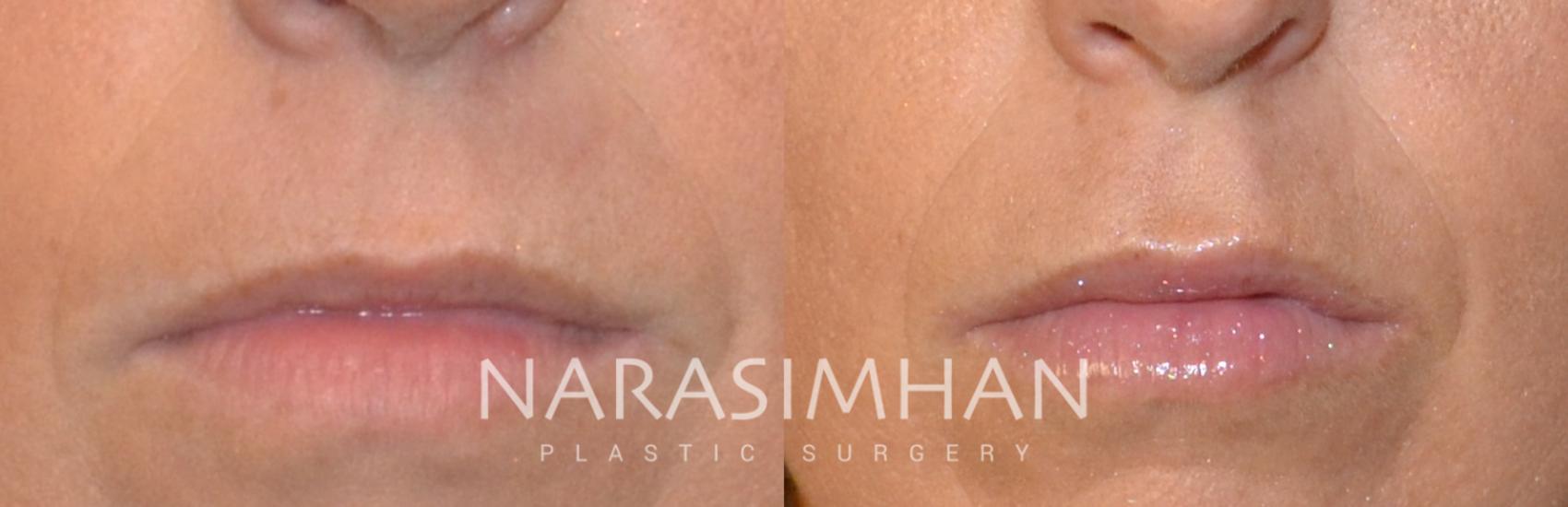 Before & After Lip Augmentation Case 118 View #1 View in St Petersburg, Florida