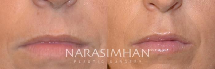 Before & After Lip Augmentation Case 118 View #1 View in Tampa, Florida