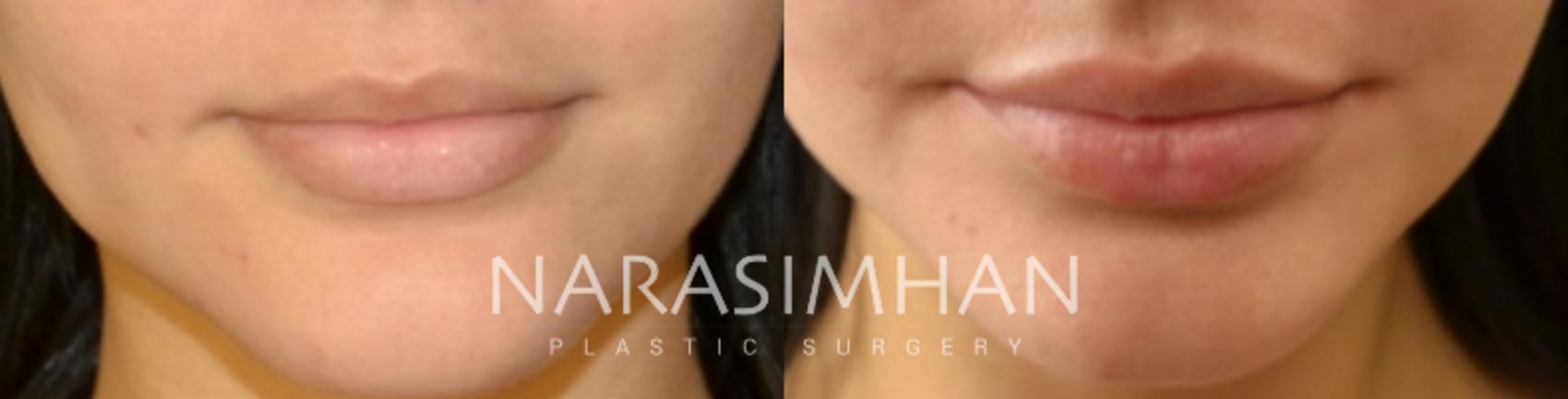 Before & After Lip Augmentation Case 143 View #1 View in St Petersburg, Florida