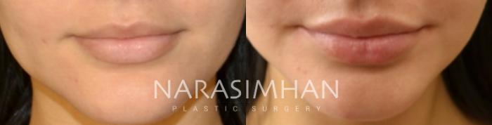 Before & After Lip Augmentation Case 143 View #1 View in Tampa, Florida