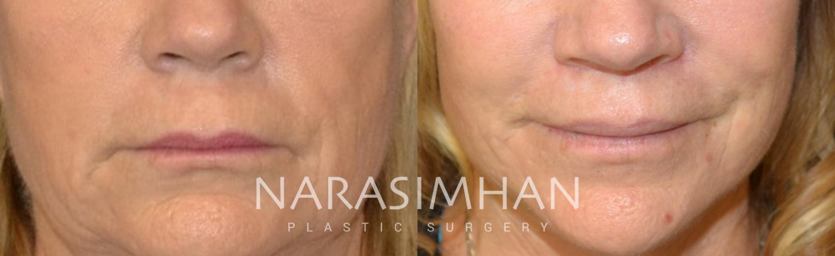 Before & After Lip Lift Case 155 View #1 View in St Petersburg, Florida