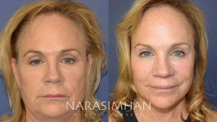 Before & After Lip Lift Case 155 View #3 View in Tampa, Florida