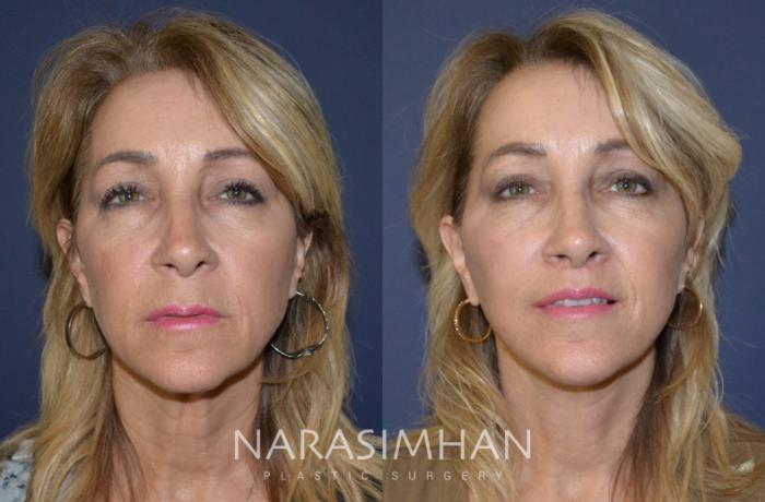 Before & After Lip Lift Case 156 View #2 View in Tampa, Florida