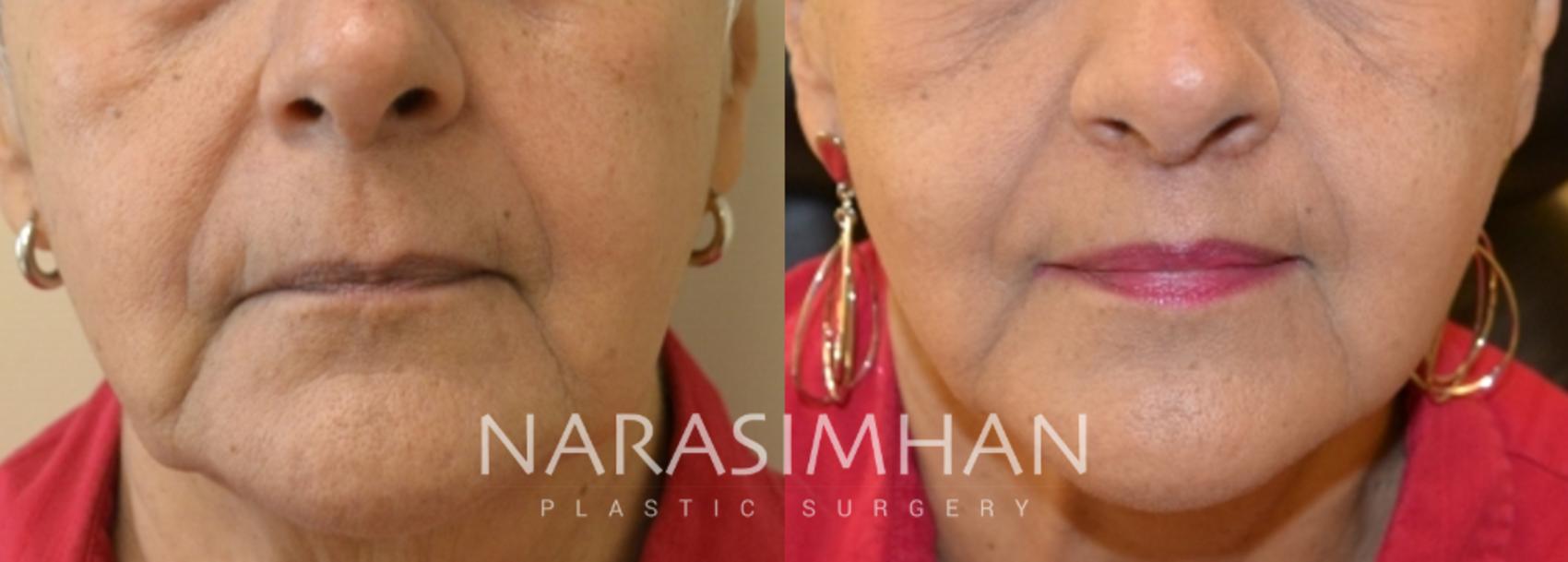 Before & After Lip Lift Case 157 View #1 View in St. Petersburg, Florida