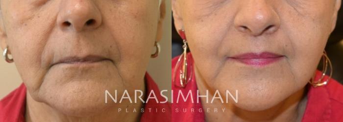 Before & After Lip Lift Case 157 View #1 View in Tampa, Florida