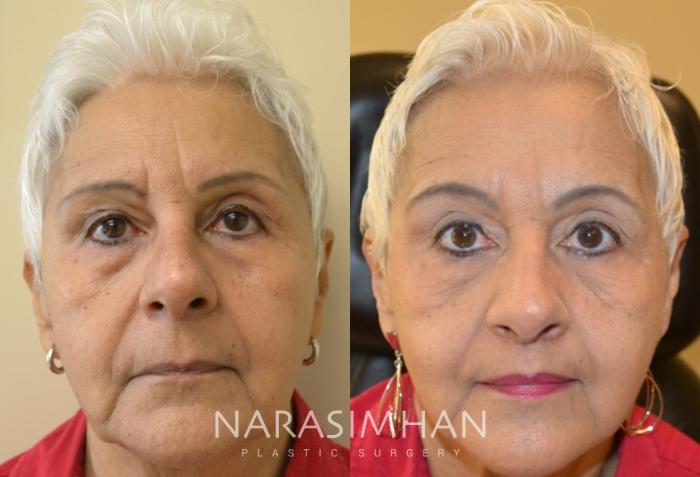 Before & After Lip Lift Case 157 View #2 View in Tampa, Florida