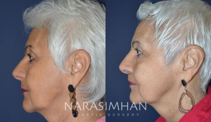 Before & After Lip Lift Case 157 View #3 View in Tampa, Florida