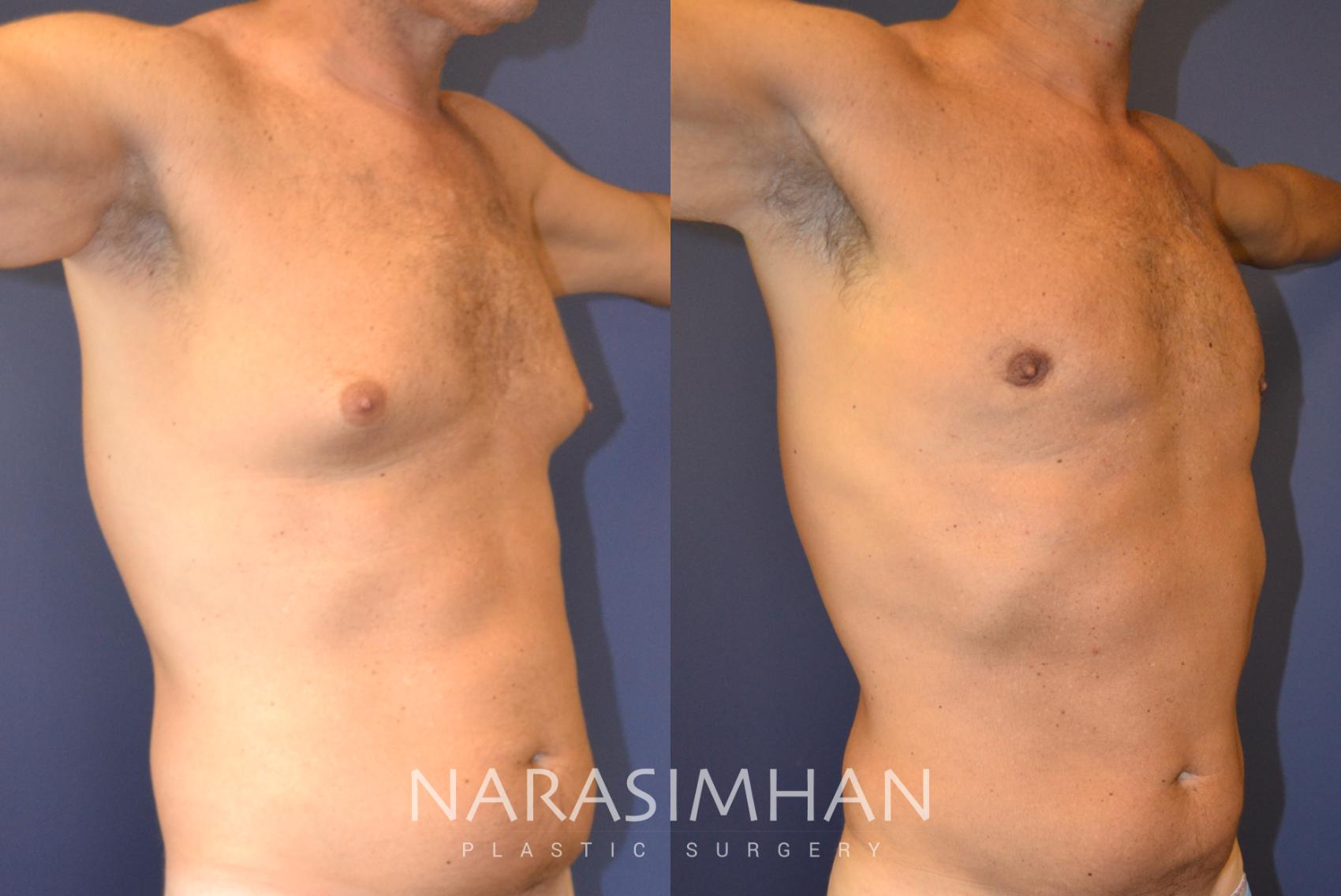 Before & After Male Breast Reduction (Gynecomastia) Case 136 View #1 View in St Petersburg, Florida