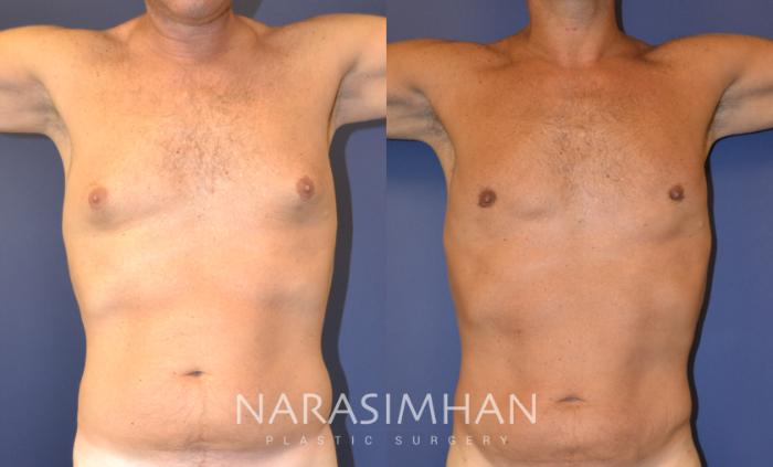 Before & After Male Breast Reduction (Gynecomastia) Case 136 View #2 View in Tampa, Florida