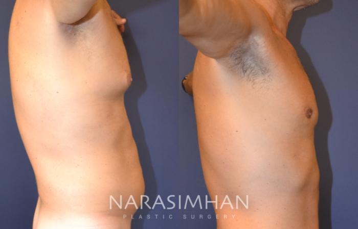 Before & After Male Breast Reduction (Gynecomastia) Case 136 View #3 View in Tampa, Florida