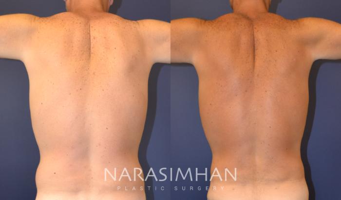 Before & After Liposuction Case 136 View #4 View in Tampa, Florida