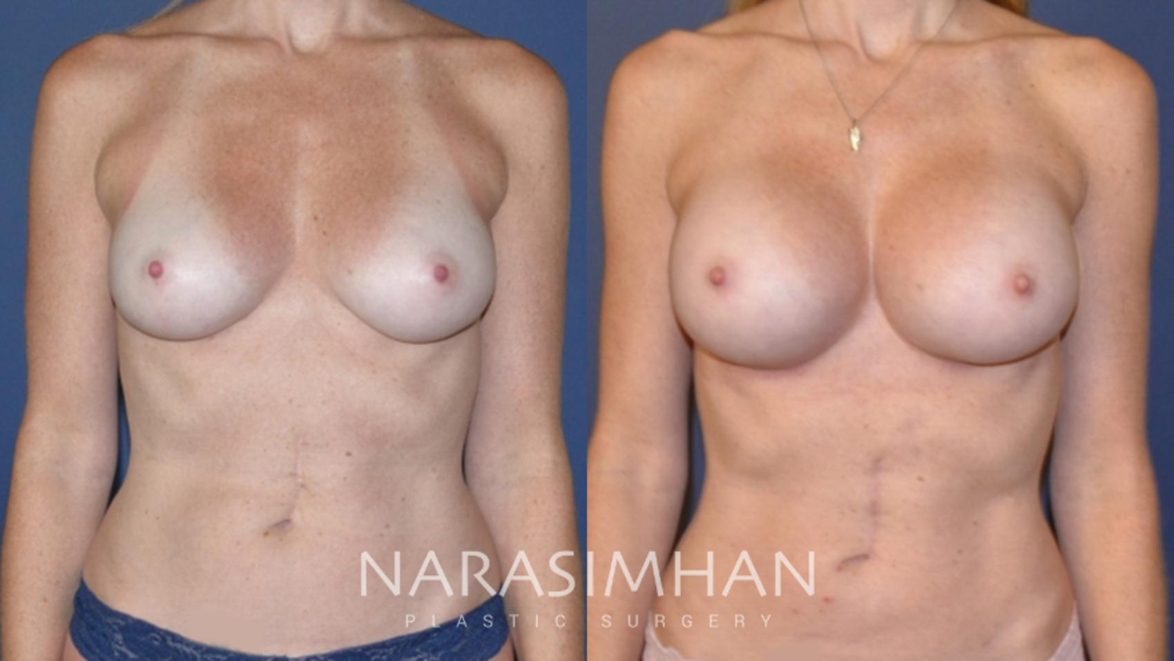 Before & After Liposuction Case 146 View #1 View in Tampa, Florida