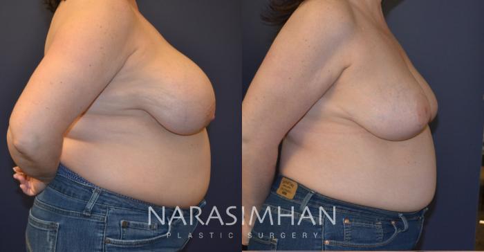 Before & After Liposuction Case 150 View #3 View in Tampa, Florida