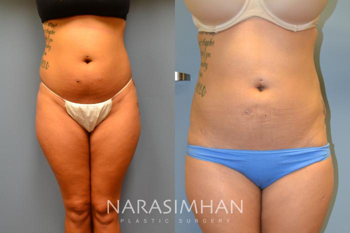 Before & After Liposuction Case 16 View #1 View in Tampa, Florida