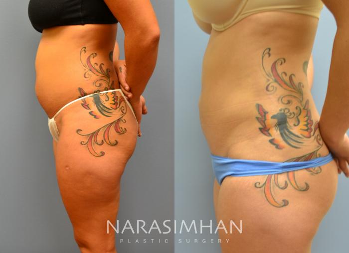 Before & After Liposuction Case 16 View #3 View in Tampa, Florida