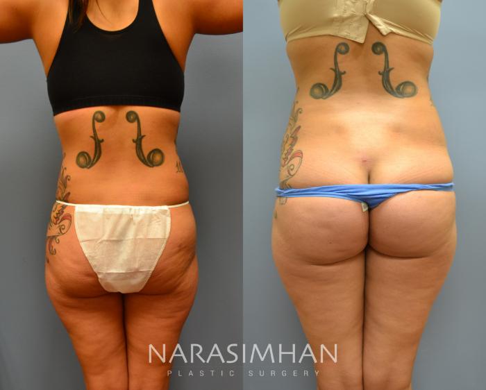 Before & After Liposuction Case 16 View #4 View in Tampa, Florida