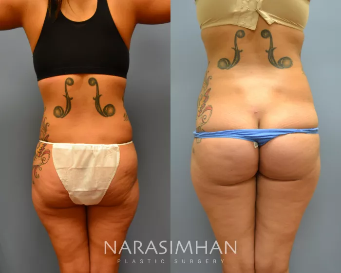 Liposuction Before & After Gallery: Patient 16