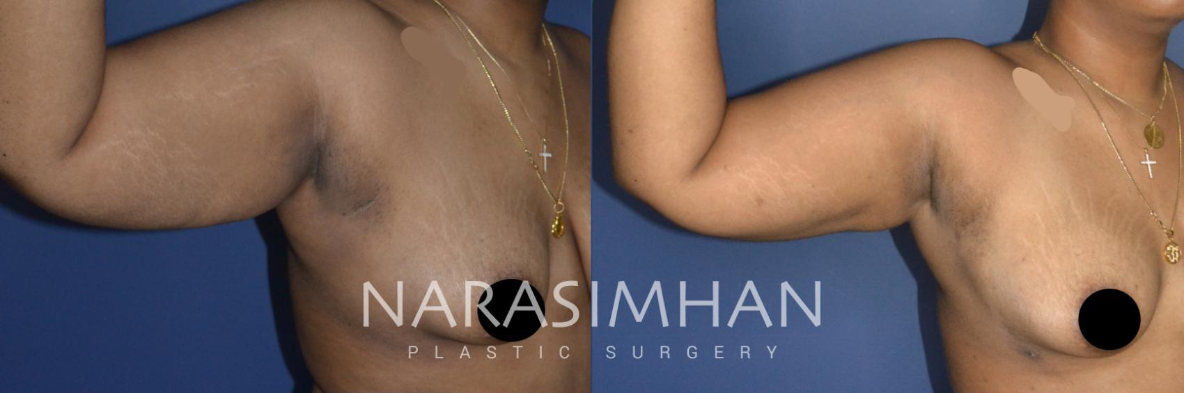 Before & After Liposuction Case 224 View #1 View in Tampa, Florida